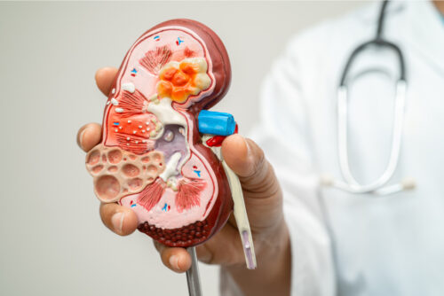 nefrectomia-por-laparoscopía-parcial-y-total​