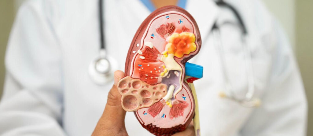 nefrolitotomia-o-extraccion-de-cuerpo-extraño-en-el-riñon-por-via-percutanea